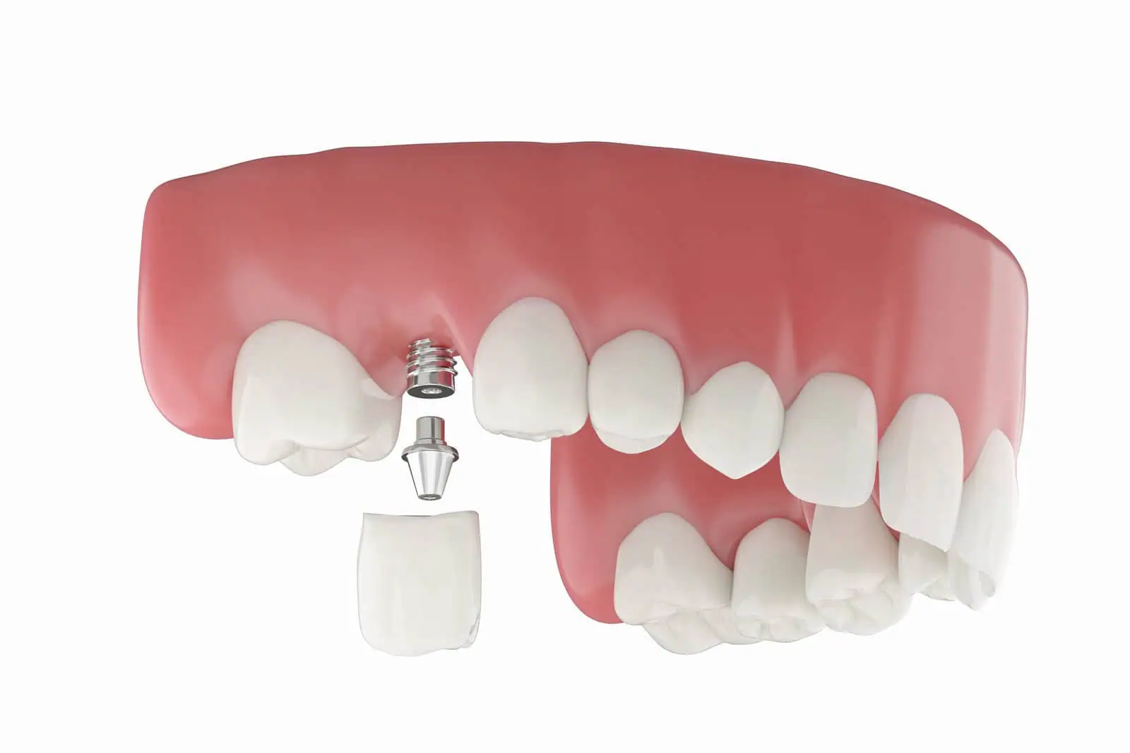 Single tooth dental implant with crown restoration